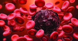 دراسة: نجاح العلاج بـ «الخلايا المعدلة» في شفاء الأطفال من سرطان الدم