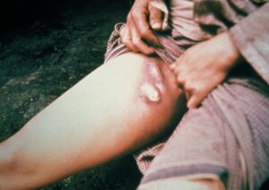 صورة لشخص مصاب بالطاعون الدملي  أو الدبلي