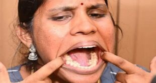 شابة هندية تدخل موسوعة غينيس بعدد أسنانها